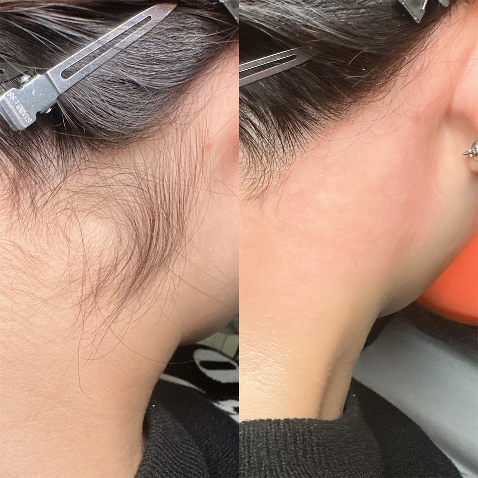 フェイシャルワックス脱毛